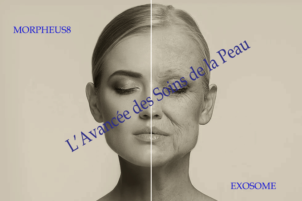 Morpheus et exosome la solution idéale